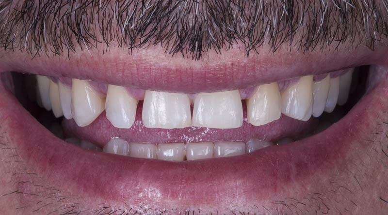 Antes